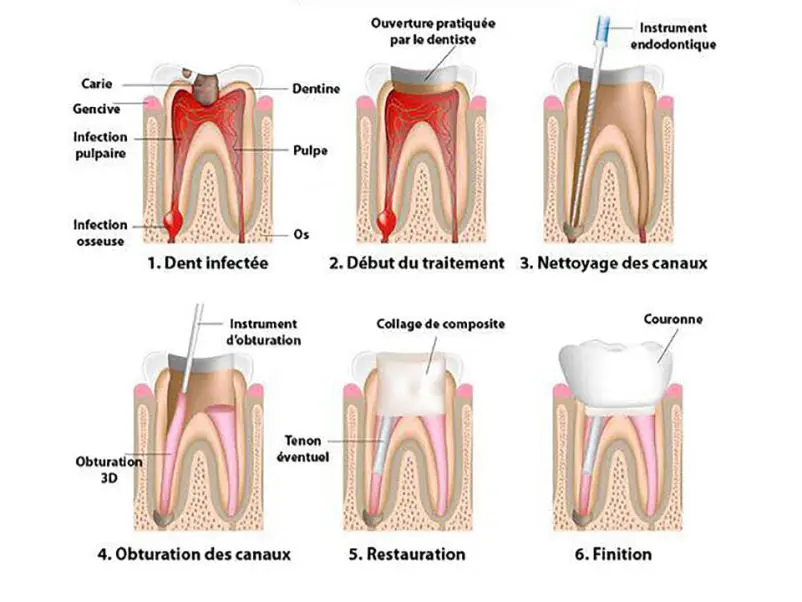 Endodontie : la technique