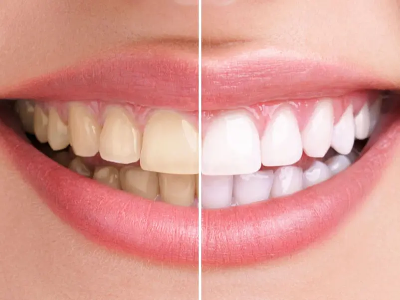 The advantages of laser tooth whitening